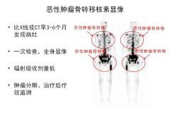 上饶市人民医院核医学科骨检查与治疗